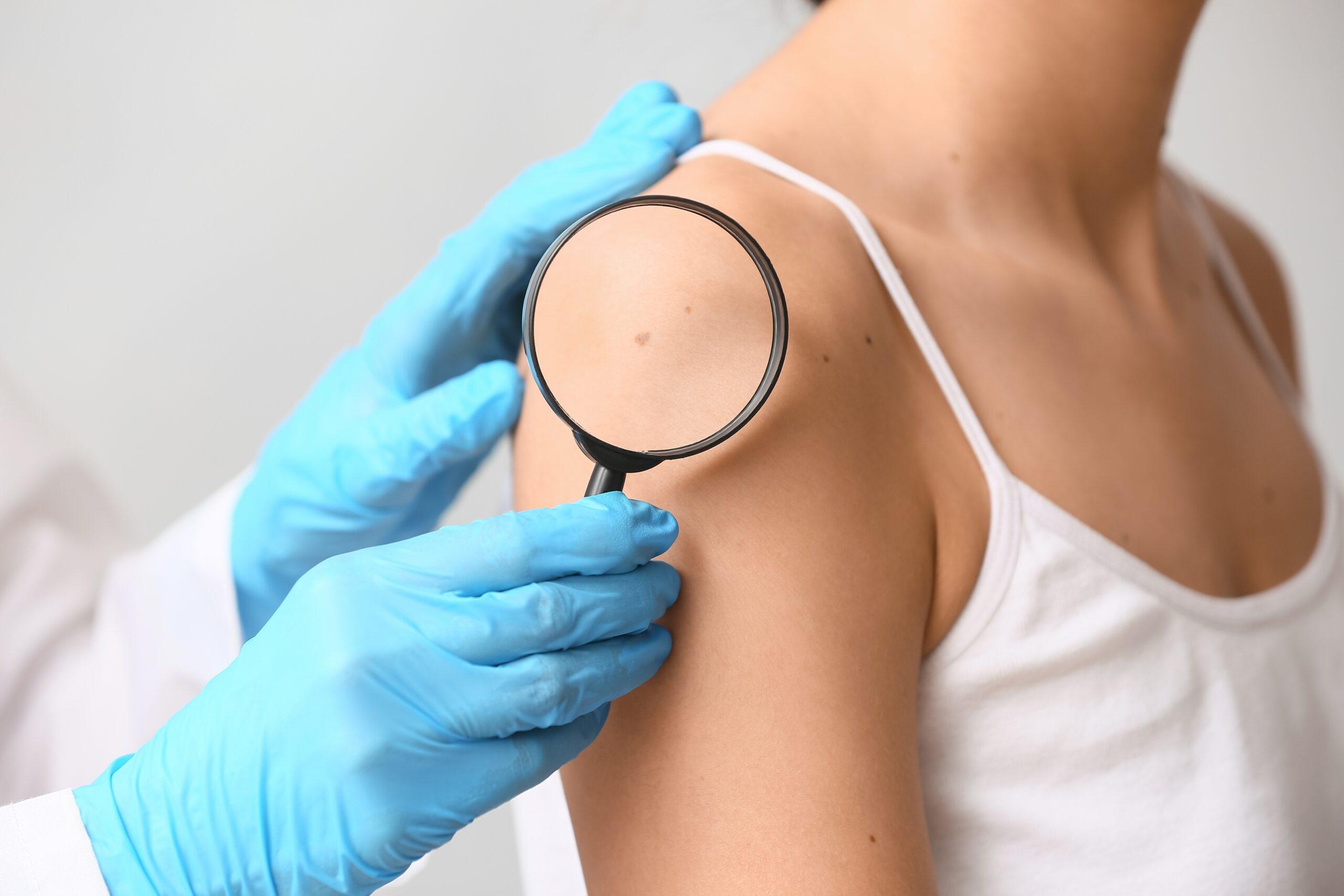 Dermatologist,With,Magnifying,Glass,Examining,Moles,Of,Young,Woman,On